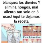 Cómo Quitar el Sarro y Blanquear tus Dientes de Forma Segura