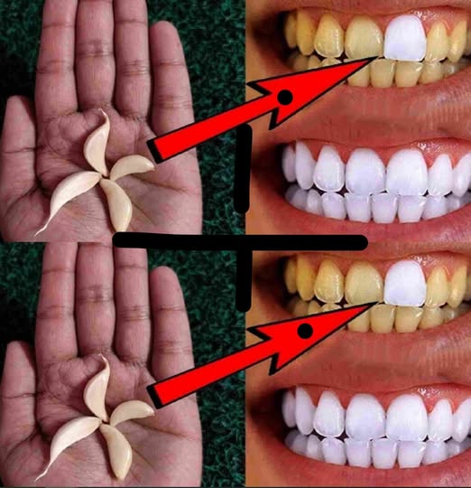 Cómo Blanquear los Dientes con Ajo